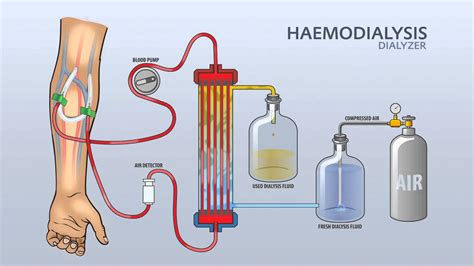dialyzers in hemodialysis.